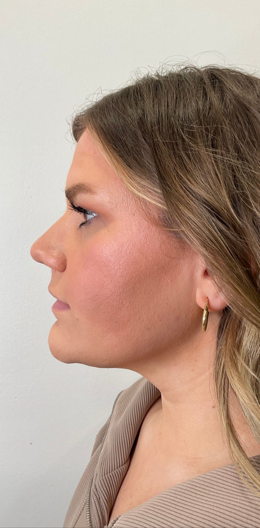 Lip Fillers Before & After Image