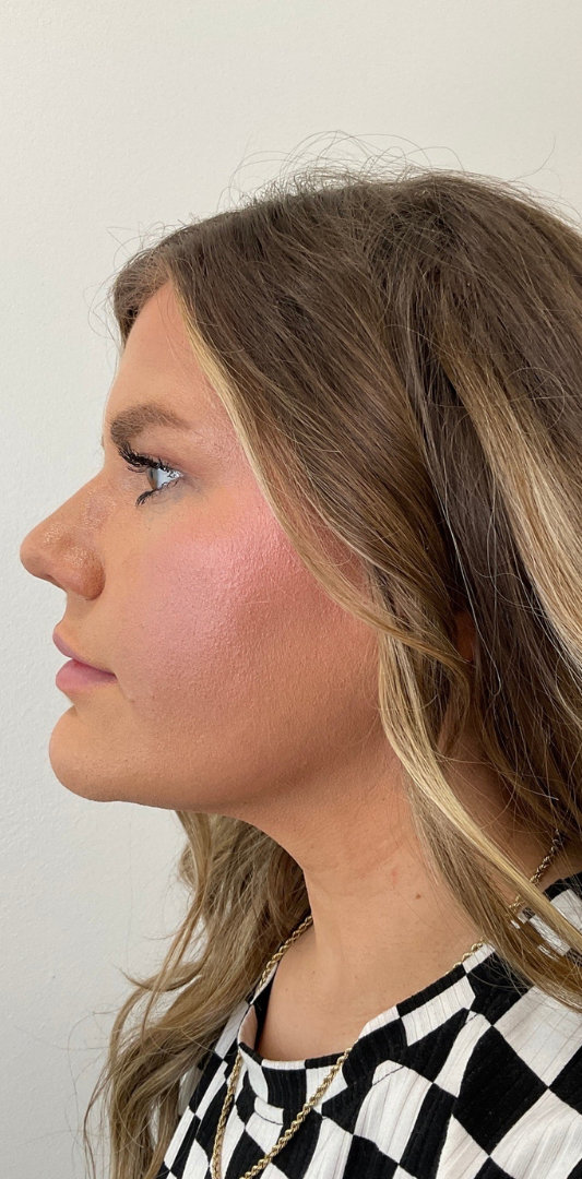 Lip Fillers Before & After Image