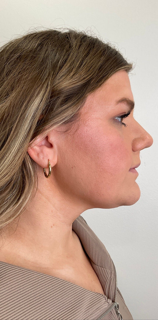 Lip Fillers Before & After Image