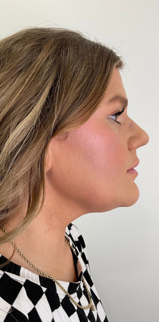 Lip Fillers Before & After Image