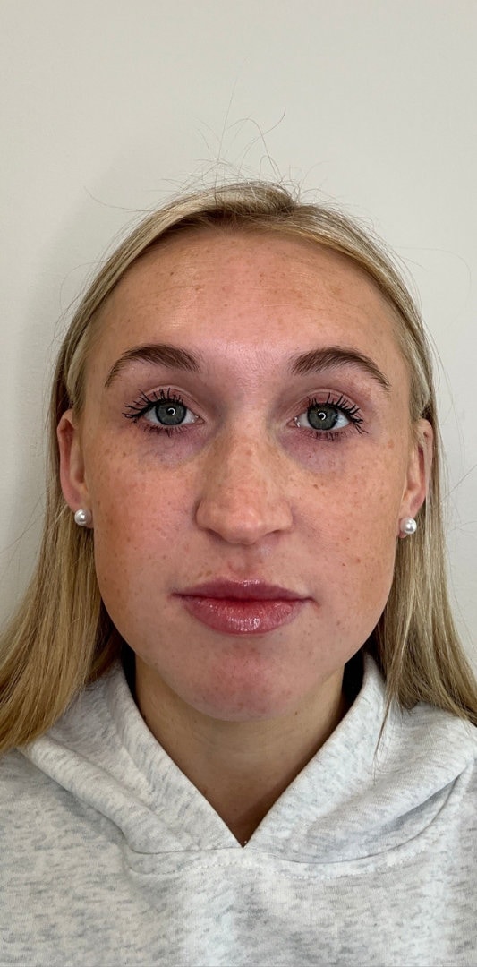 Lip Fillers Before & After Image