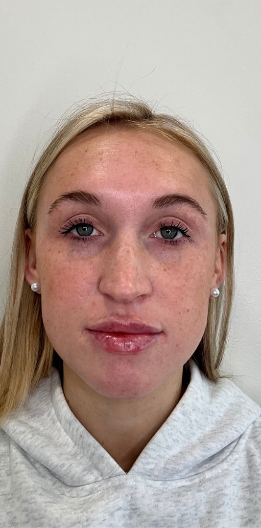Lip Fillers Before & After Image