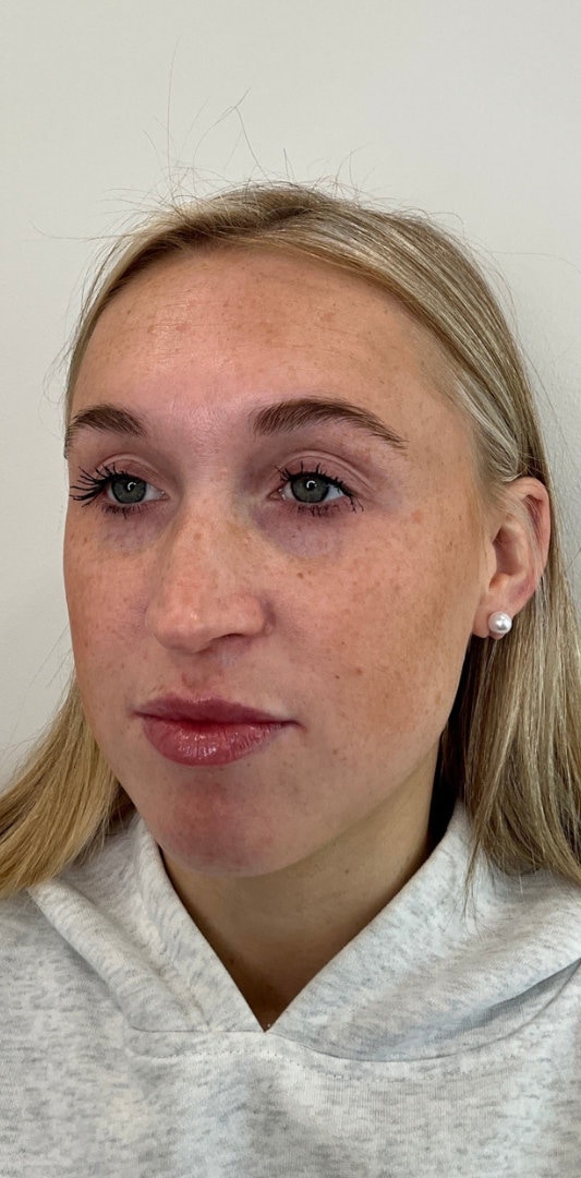 Lip Fillers Before & After Image