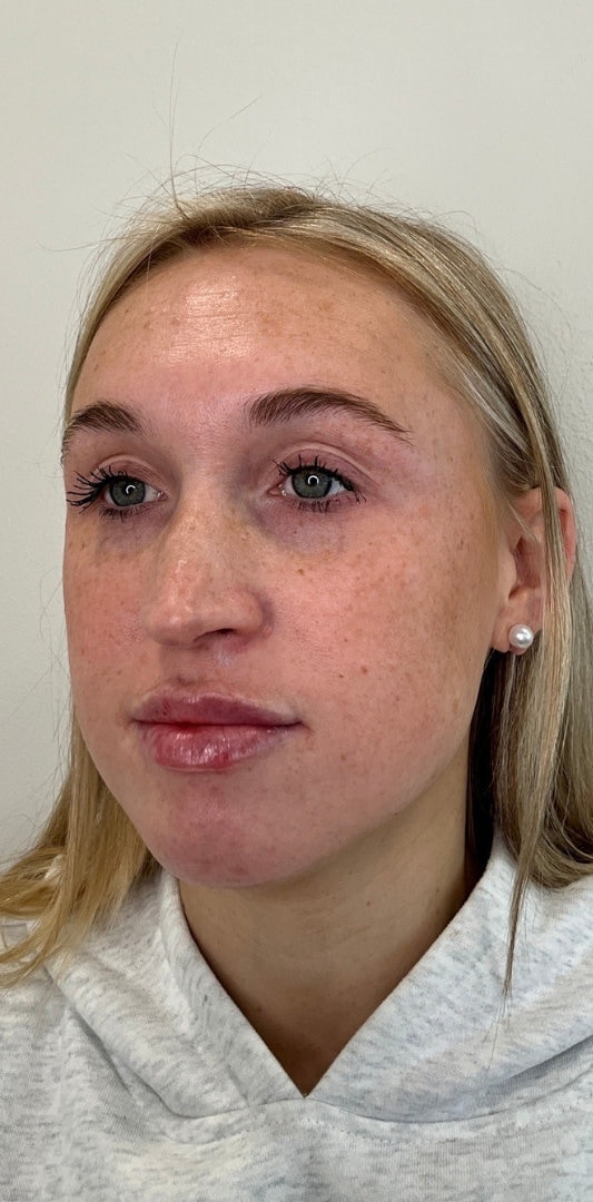 Lip Fillers Before & After Image