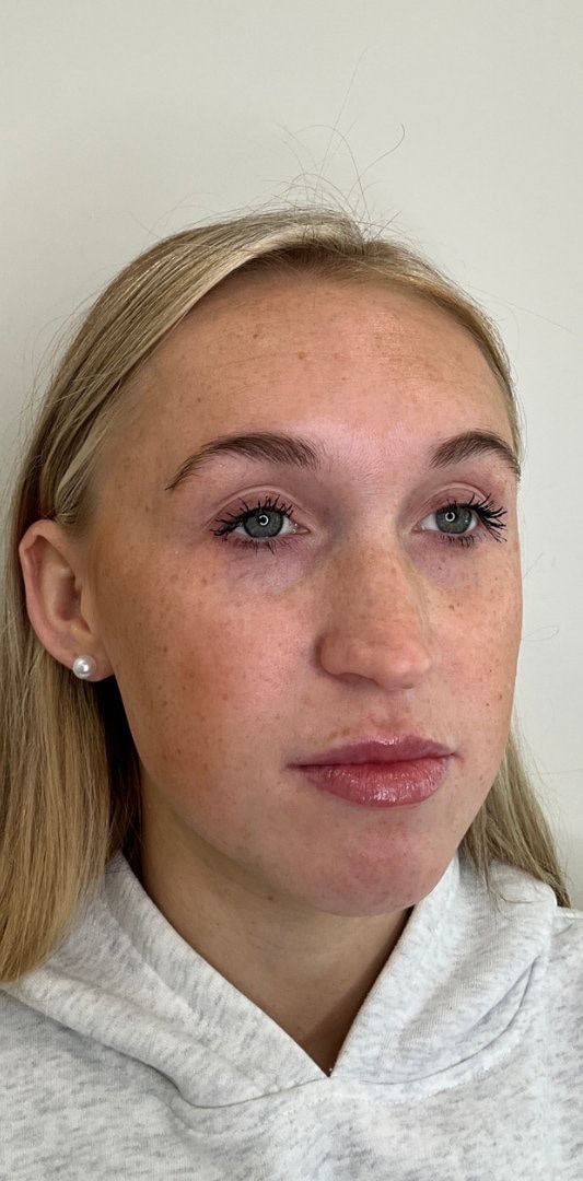 Lip Fillers Before & After Image