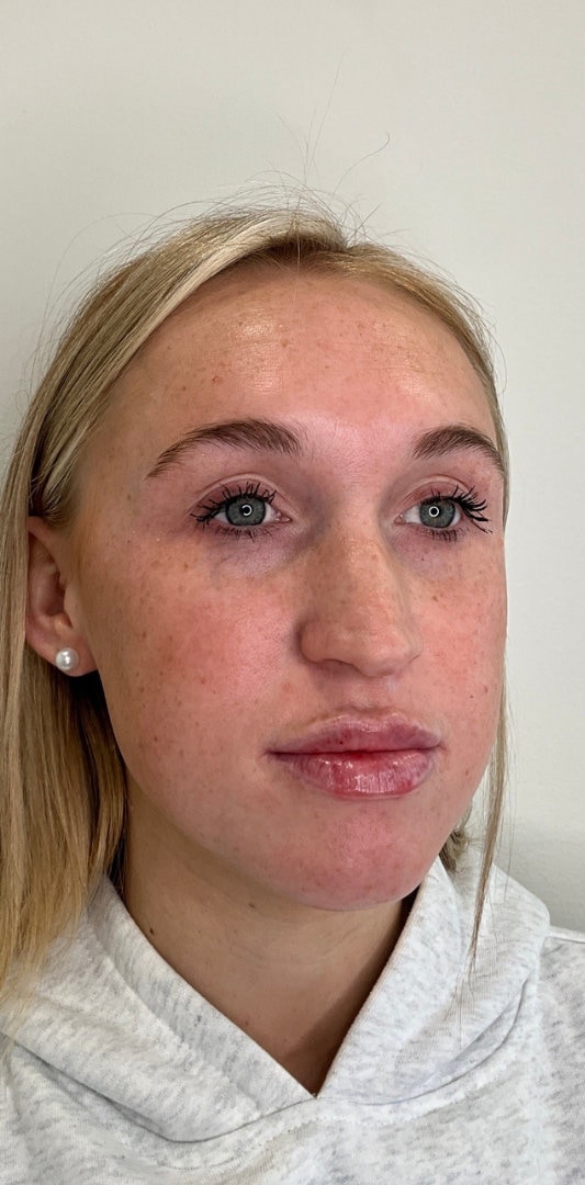 Lip Fillers Before & After Image