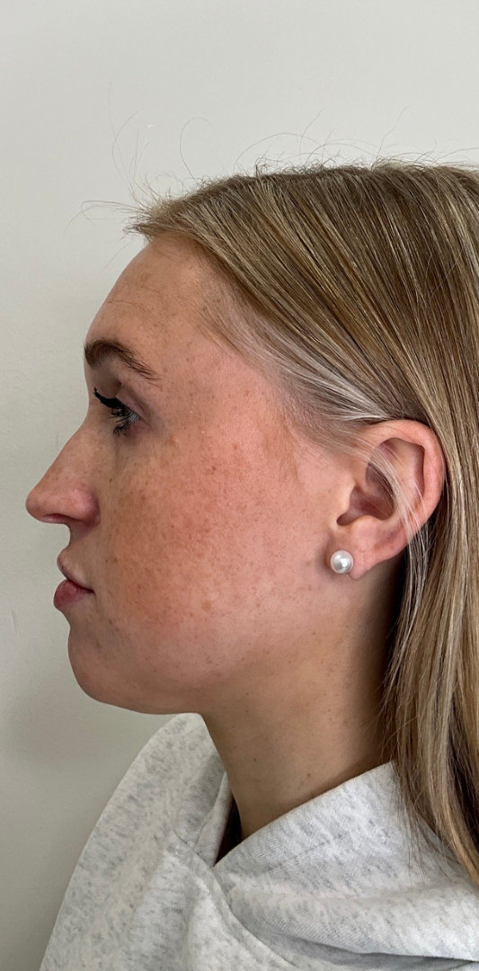 Lip Fillers Before & After Image