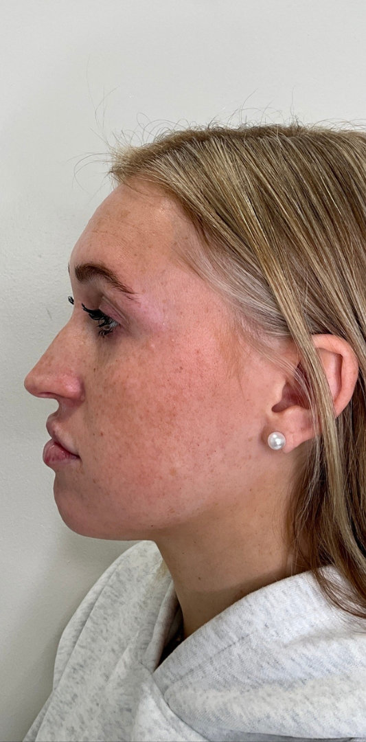 Lip Fillers Before & After Image