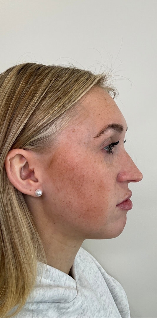 Lip Fillers Before & After Image