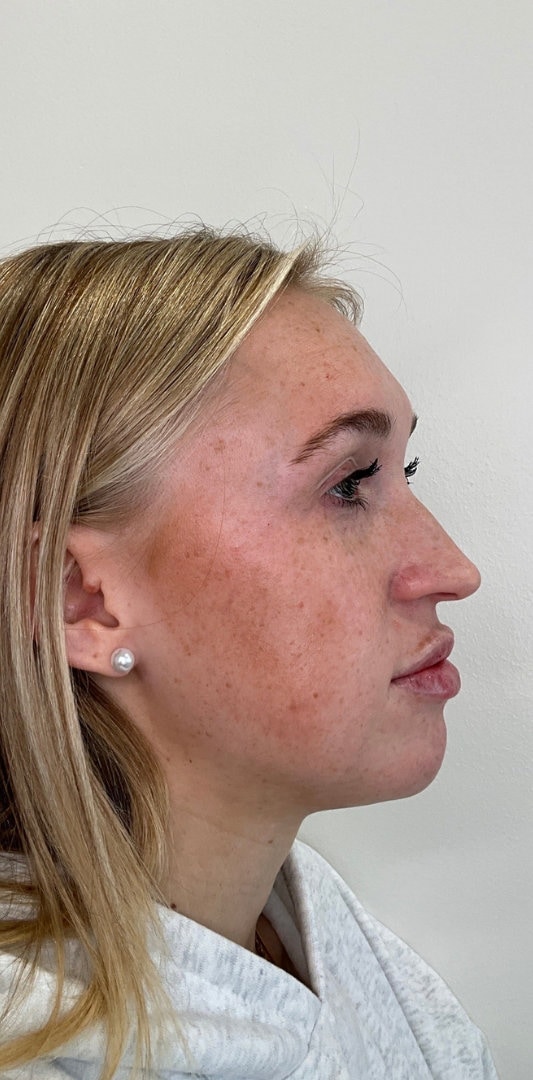 Lip Fillers Before & After Image