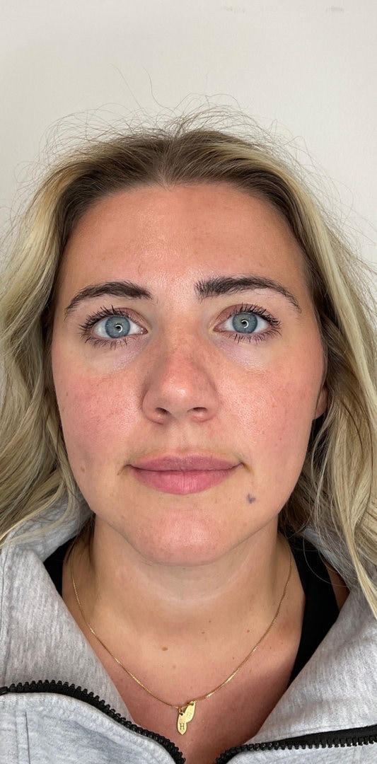 Lip Fillers Before & After Image
