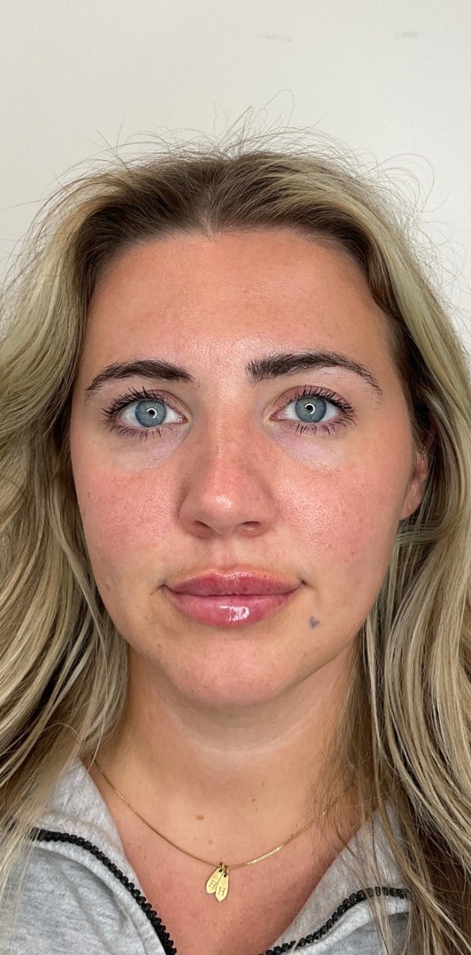 Lip Fillers Before & After Image