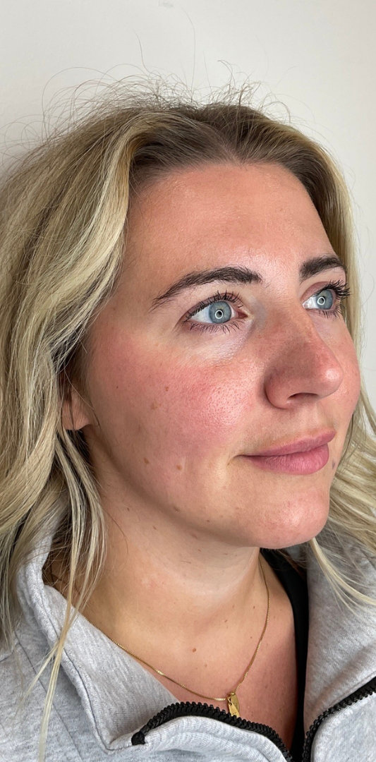 Lip Fillers Before & After Image