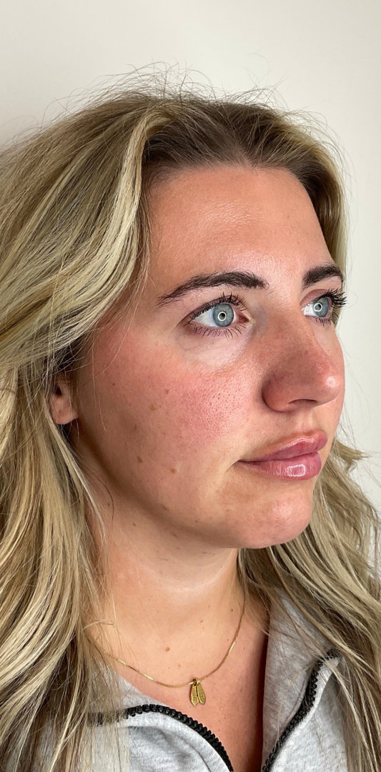 Lip Fillers Before & After Image