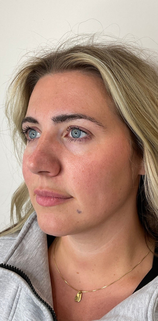 Lip Fillers Before & After Image