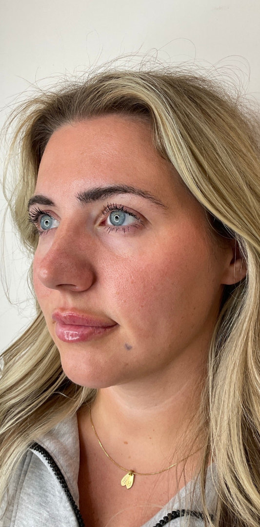 Lip Fillers Before & After Image