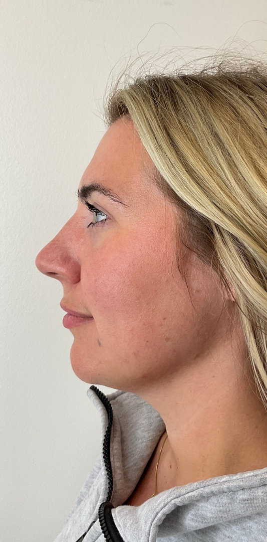 Lip Fillers Before & After Image