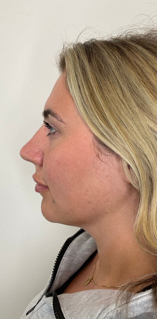 Lip Fillers Before & After Image