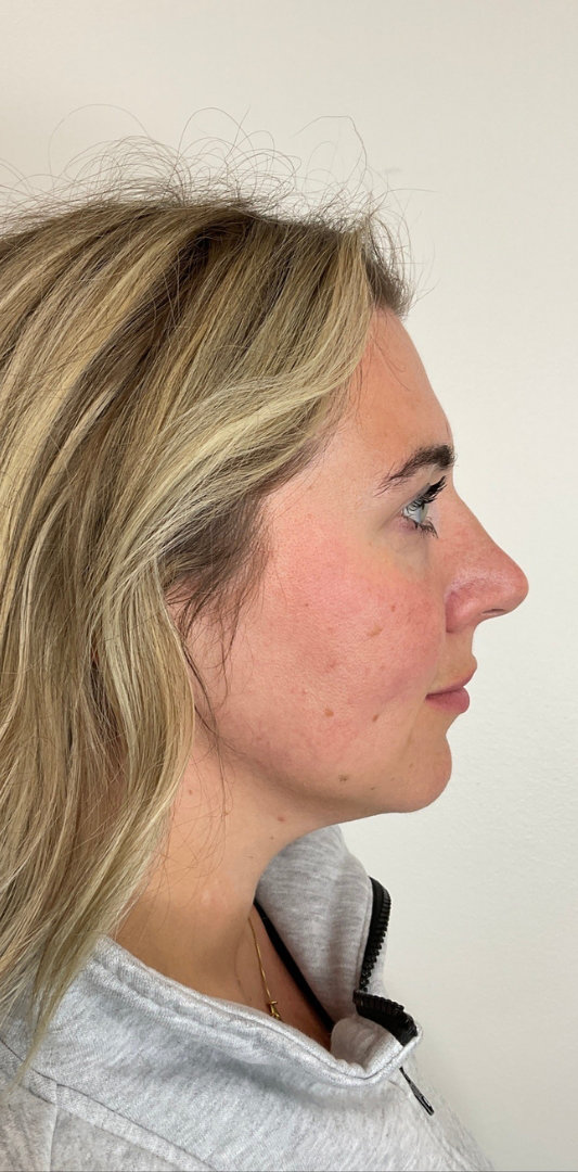 Lip Fillers Before & After Image