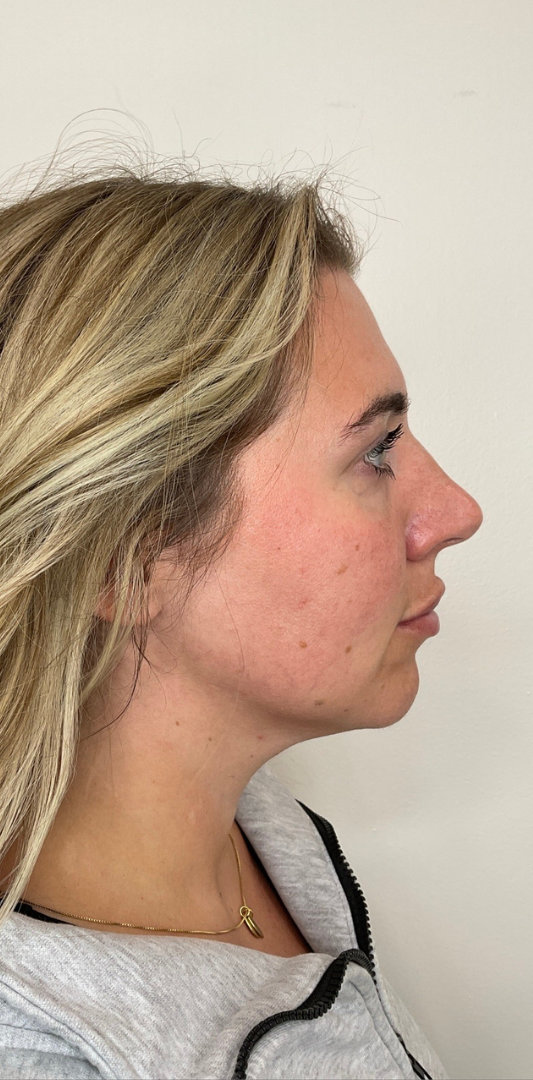 Lip Fillers Before & After Image