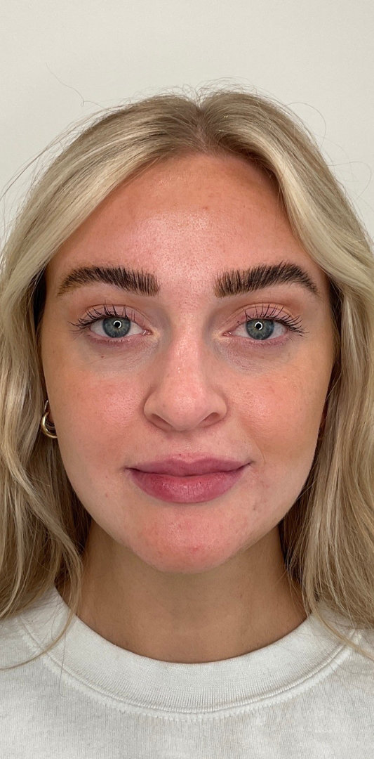 Lip Fillers Before & After Image