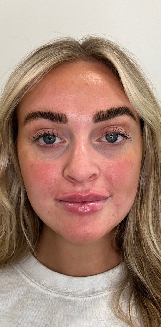 Lip Fillers Before & After Image
