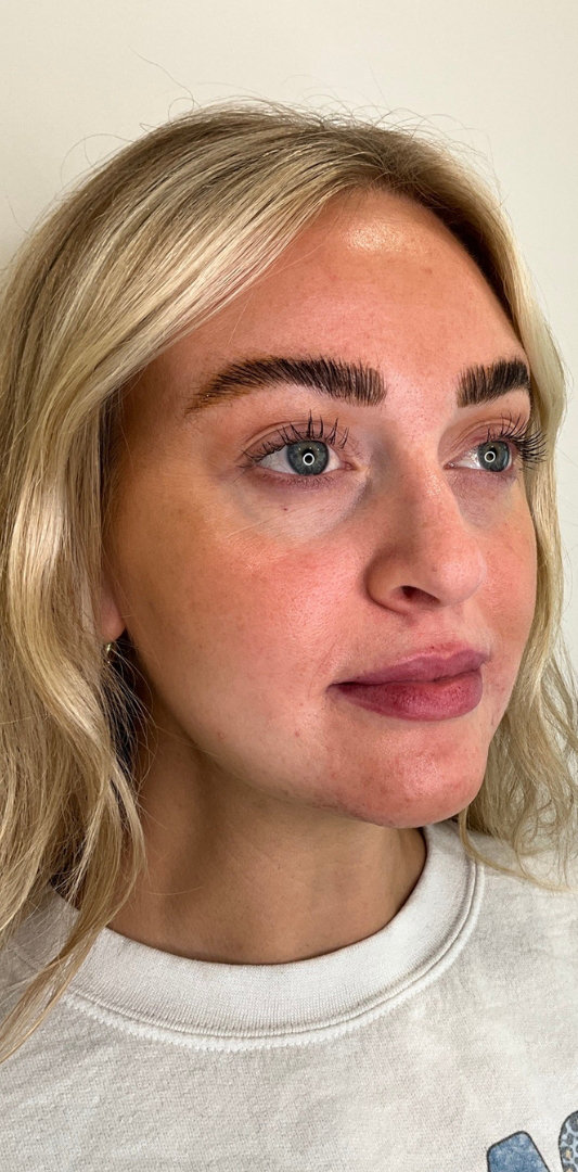 Lip Fillers Before & After Image