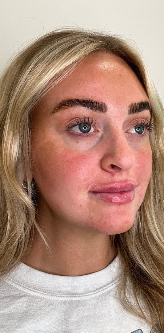 Lip Fillers Before & After Image
