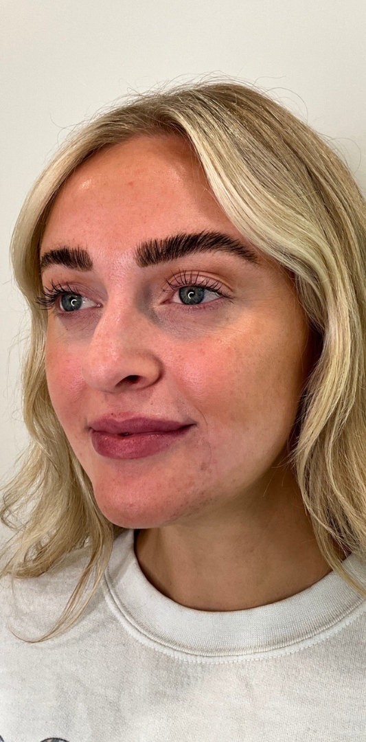 Lip Fillers Before & After Image