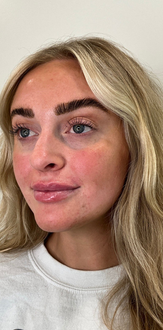 Lip Fillers Before & After Image