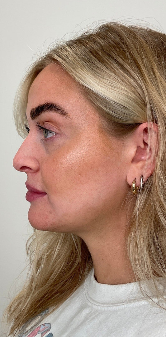 Lip Fillers Before & After Image