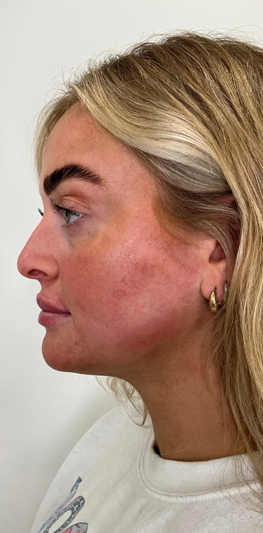 Lip Fillers Before & After Image