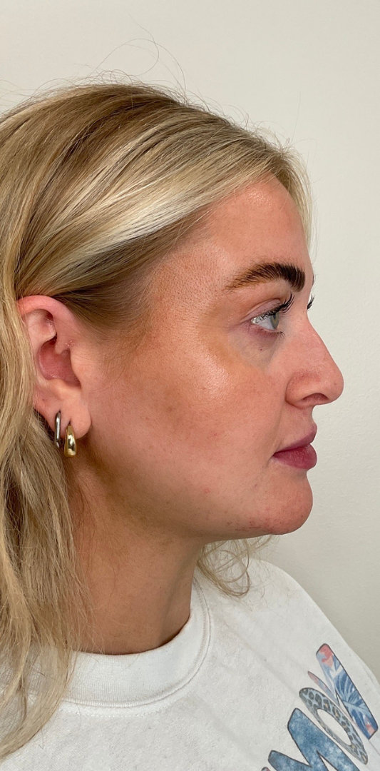 Lip Fillers Before & After Image
