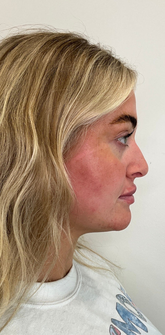 Lip Fillers Before & After Image
