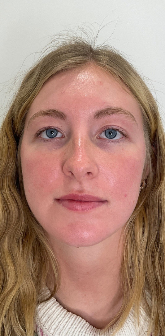 Lip Fillers Before & After Image