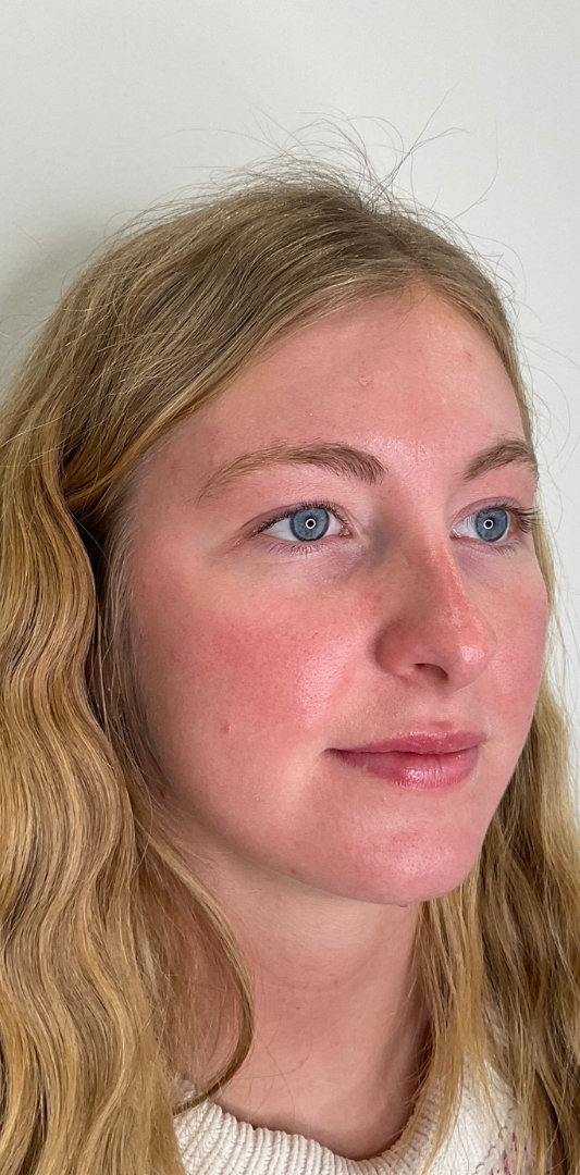 Lip Fillers Before & After Image