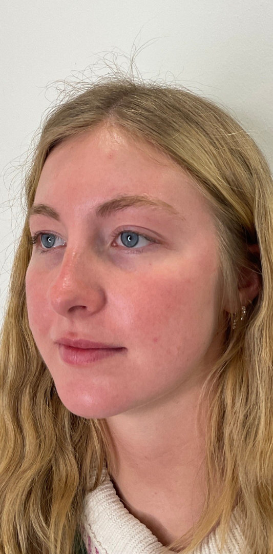 Lip Fillers Before & After Image