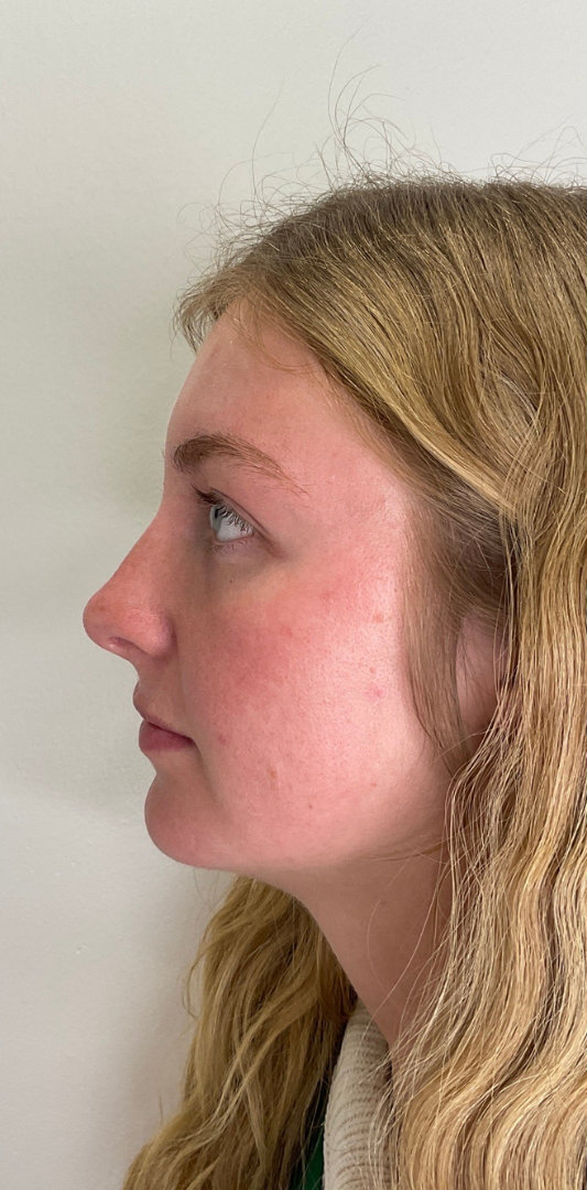 Lip Fillers Before & After Image
