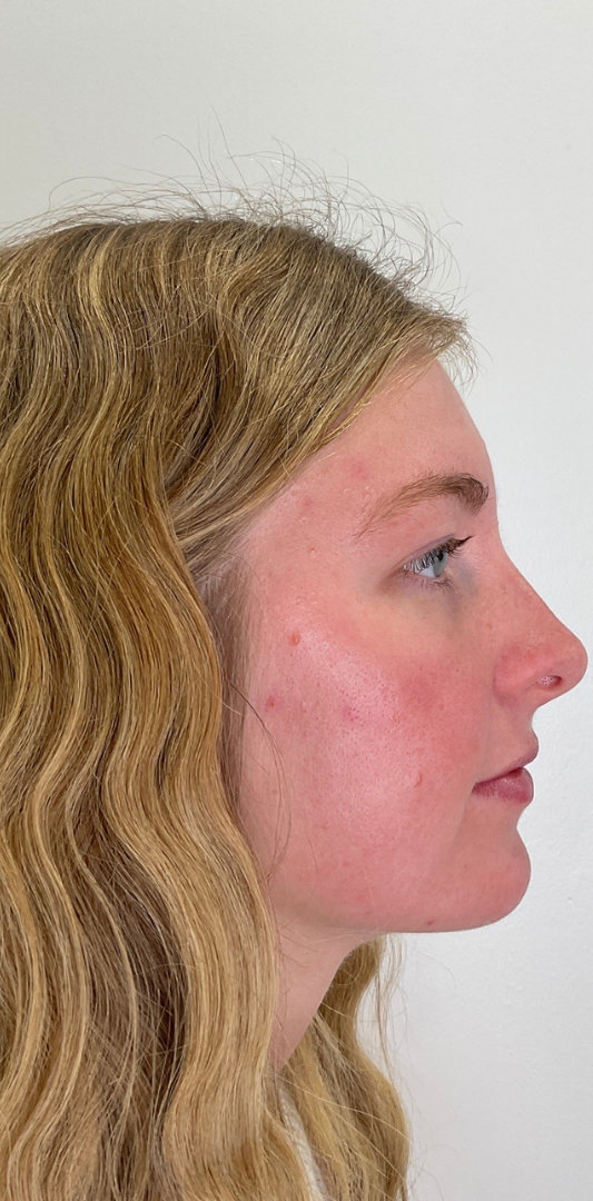 Lip Fillers Before & After Image