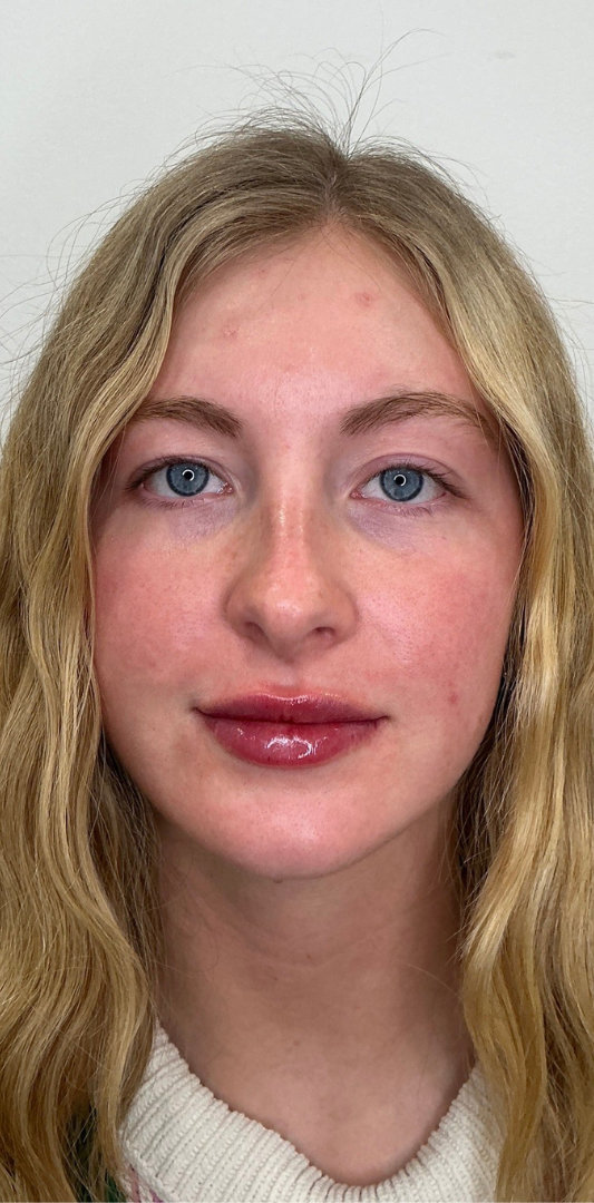 Lip Fillers Before & After Image
