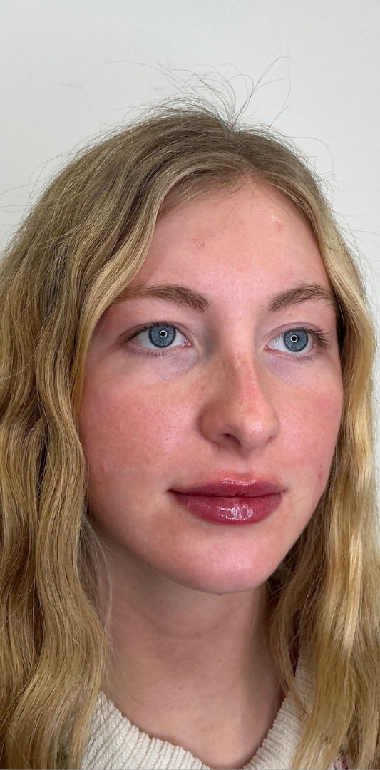 Lip Fillers Before & After Image
