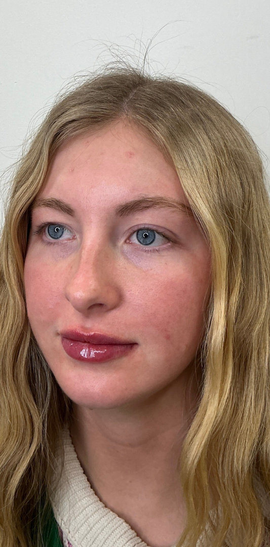 Lip Fillers Before & After Image