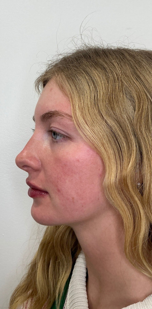 Lip Fillers Before & After Image