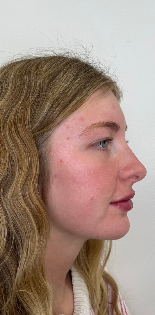 Lip Fillers Before & After Image