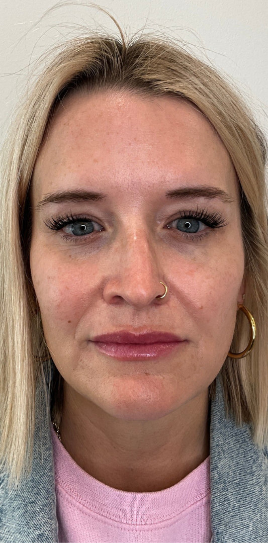 Lip Fillers Before & After Image