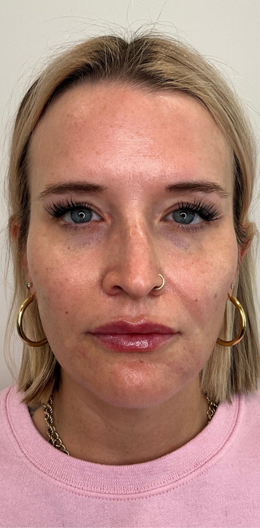 Lip Fillers Before & After Image