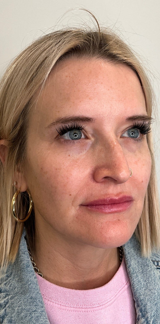 Lip Fillers Before & After Image