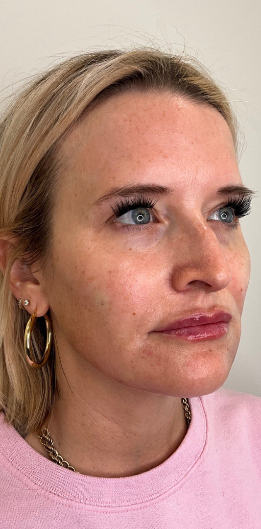 Lip Fillers Before & After Image