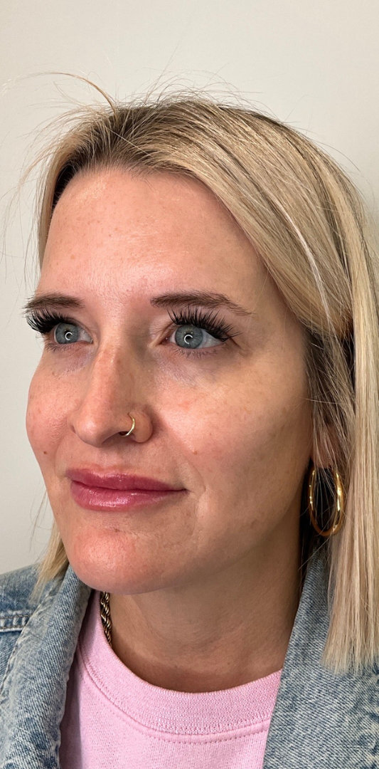 Lip Fillers Before & After Image