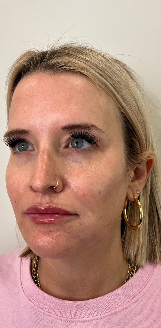 Lip Fillers Before & After Image